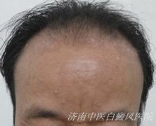 白斑出现在男性面部是为什么