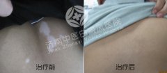 腰部为什么会患上白癜风