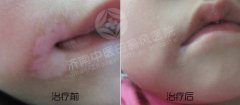 婴儿白癜风要注意什么