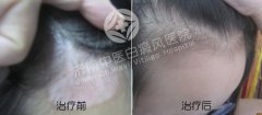 女性白癜风患者应该注意什么