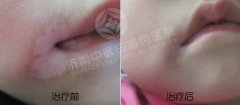 怎么治疗青少年白癜风