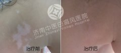 白癜风怎么治疗有效果