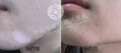 怎么治疗脸部白癜风呢