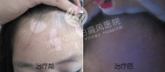 怎么治疗女性白癜风比较好