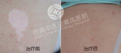 女性如何预防白驳风的诱发