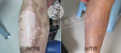治疗白癜风的药物有哪些呢